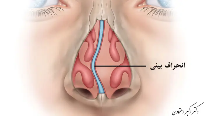 عمل انحراف بینی و تغییر فرم بینی