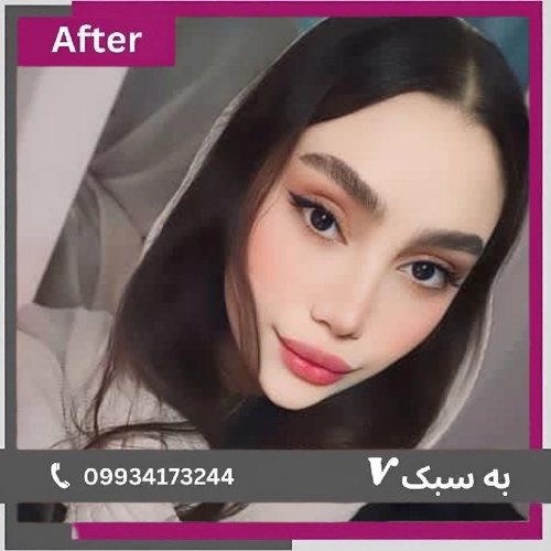 نمونه کار جراحی بینی استخوانی دکتر آرزو خوانساری‌نیا 4