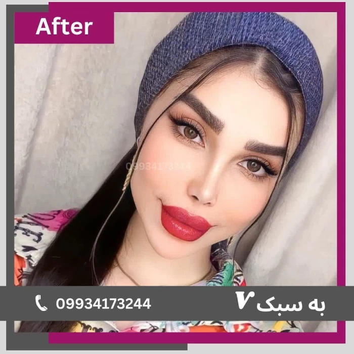 نمونه کار جراحی بینی استخوانی دکتر آرزو خوانساری‌نیا 1