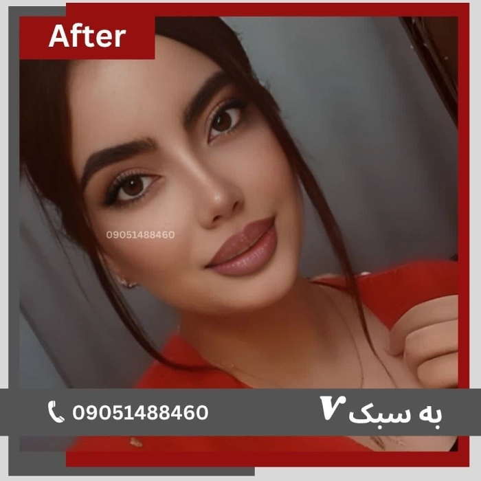نمونه کار جراحی بینی توسط دکتر خسرو مقتدر - 4