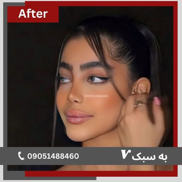 نمونه کار جراحی بینی توسط دکتر خسرو مقتدر - 5