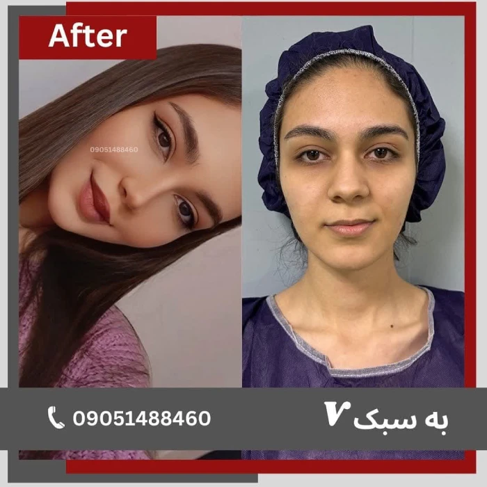 نمونه جراحی بینی عروسکی توسط دکتر خسرو مقتدر