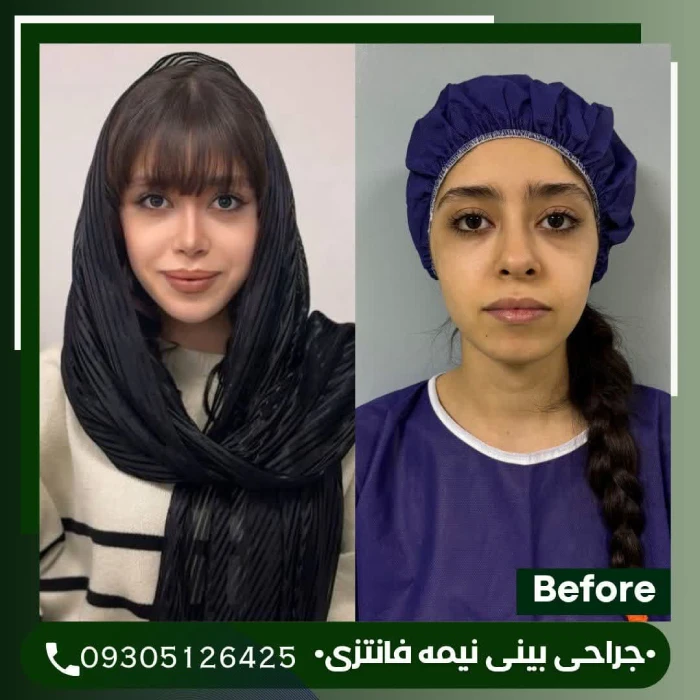 نمونه کار جراحی بینی توسط دکتر علی شکرریز - 2