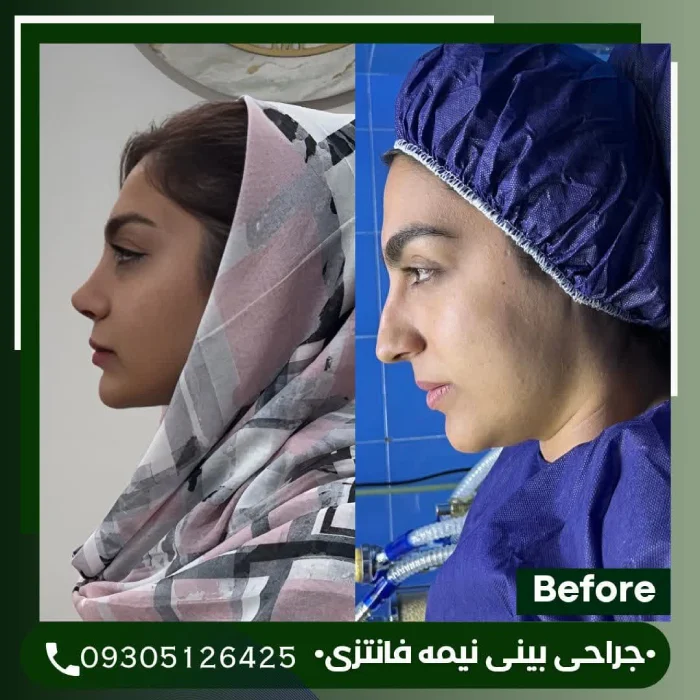 نمونه کار جراحی بینی توسط دکتر علی شکرریز - 3