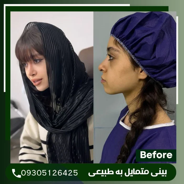 نمونه کار جراحی بینی توسط دکتر علی شکرریز - 4