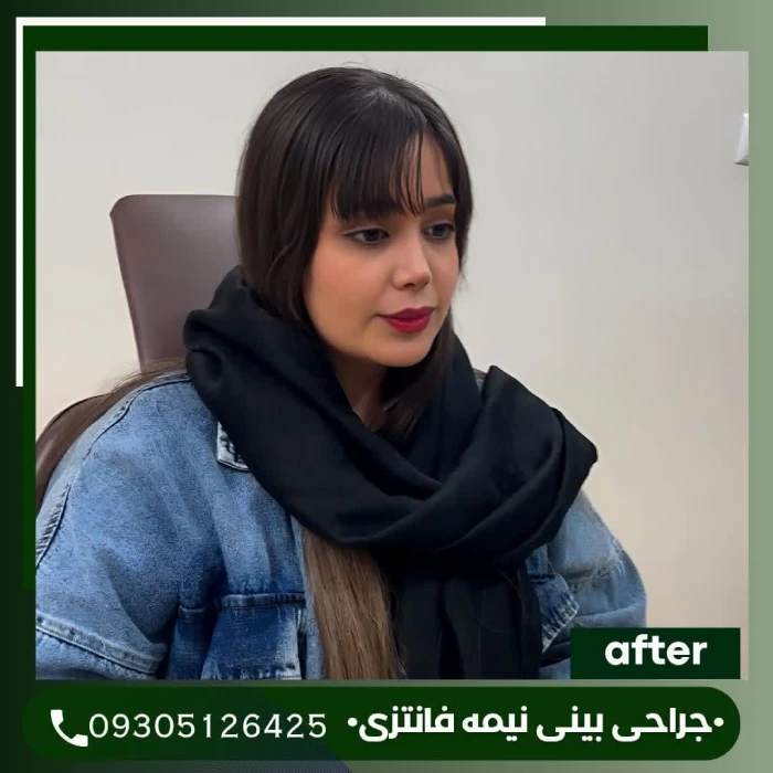 نمونه کار جراحی بینی توسط دکتر علی شکرریز - 1