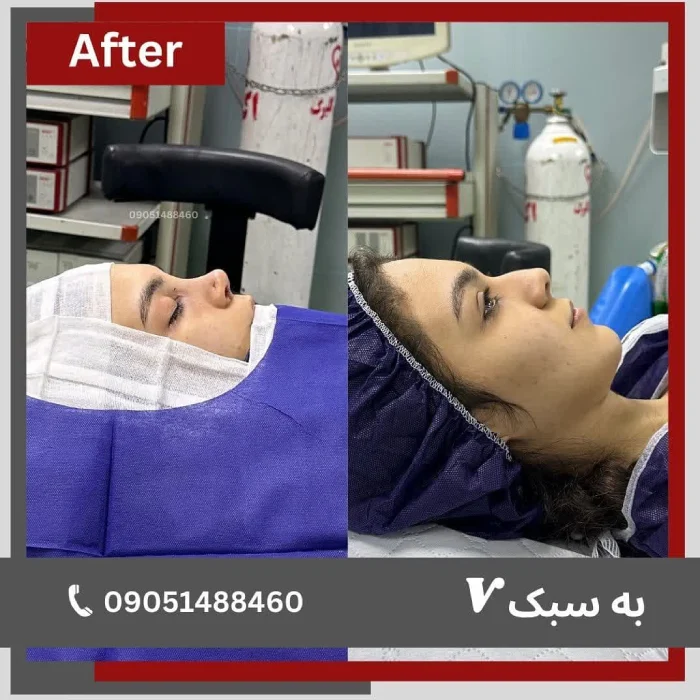 نمونه جراحی زیبایی بینی دکتر خسرو مقتدر