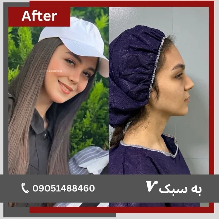 نمونه جراحی بینی توسط دکتر خسرو مقتدر در تهران