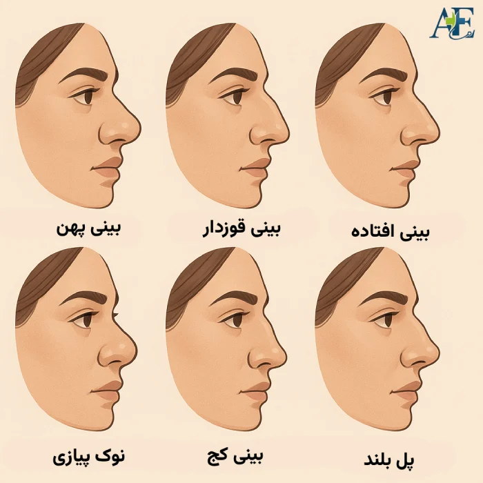 انواع عمل بینی طبیعی - بهترین جراح بینی طبیعی در تهران