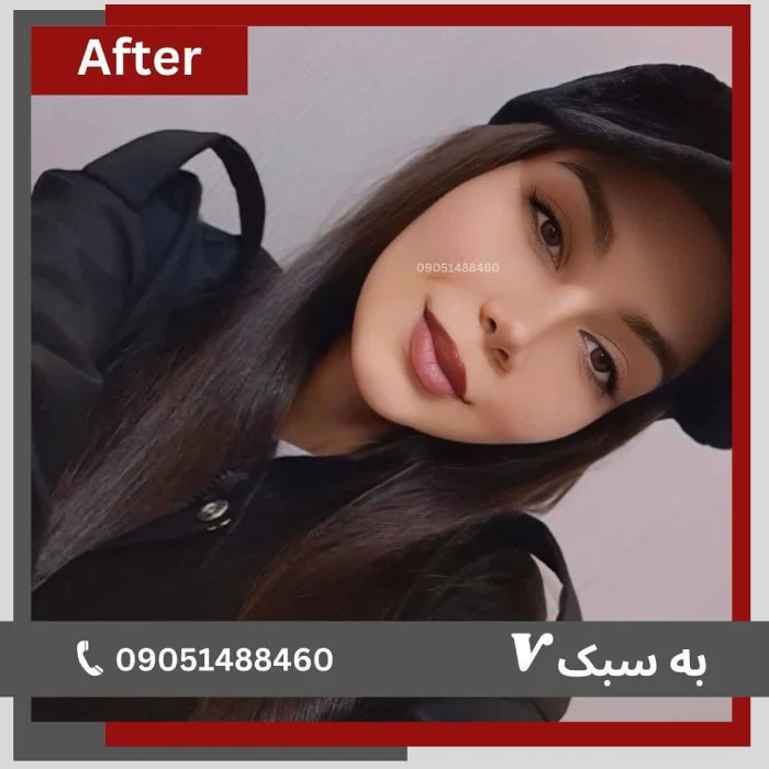 نمونه کار جراحی بینی توسط دکتر خسرو مقتدر - 1