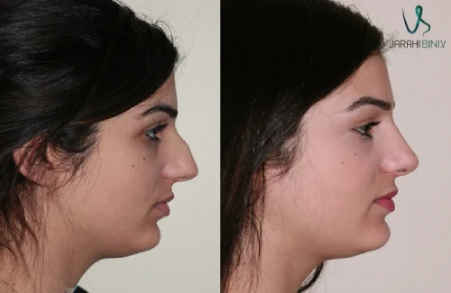 نمونه‌کار ۵ دکتر علی شکرریز | بهترین جراح بینی گوشتی در تهران | کاهش ضخامت بافت نرم و نتیجه پایدار