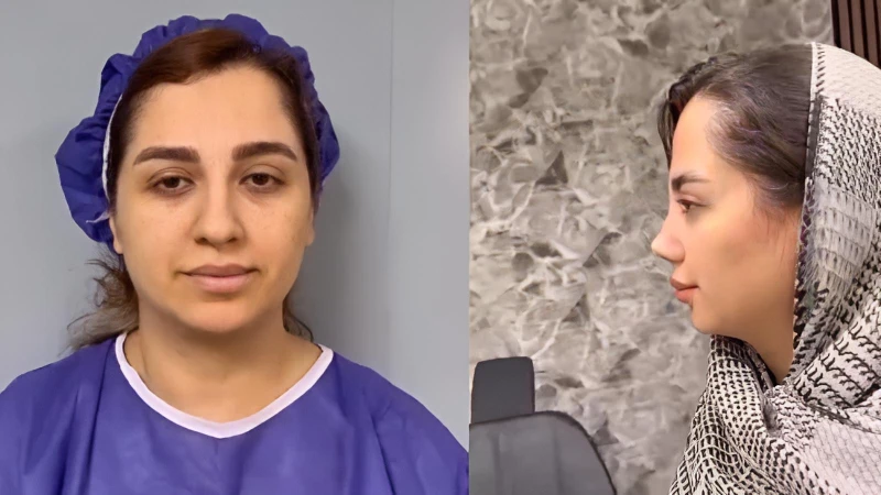 جراحی بینی گوشتی در تهران توسط دکتر علی شکرریز | کوچک‌سازی پره‌ها و اصلاح نوک