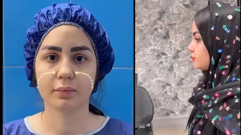 قبل و بعد عمل بینی گوشتی طبیعی | دکتر علی شکرریز (تهران) | قرینگی و تنفس بهتر