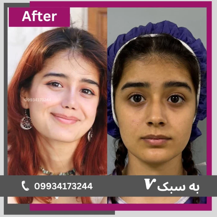 نمونه جراحی بینی عروسکی توسط دکتر آرزو خوانساری‌نیا