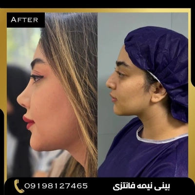 جراحی بینی استخوانی دکتر امین بختیاری - نمونه 2
