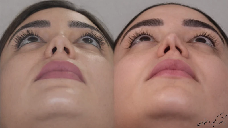 جراحی بینی ترمیمی