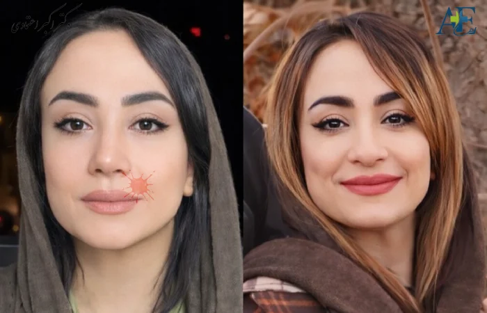 عوارض بلندمدت عمل بینی گوشتی