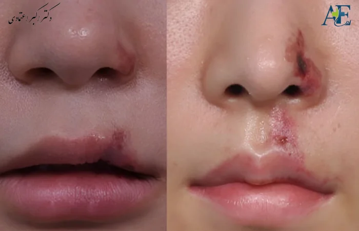 عوارض دائمی جراحی بینی
