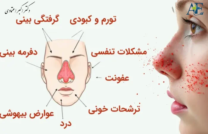 عوارض بلند مدت جراحی بینی