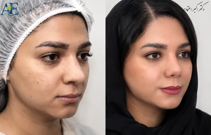 برگشت بینی گوشتی بعد از عمل