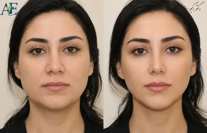 جراحی بینی گوشتی