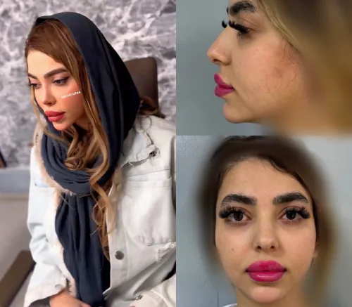 نتیجه جراحی بینی توسط دکتر آرزو خوانسارینیا نتیجه جراحی بینی توسط دکتر آرزو خوانسارینیا با توجه به تناسب بینی و چهره