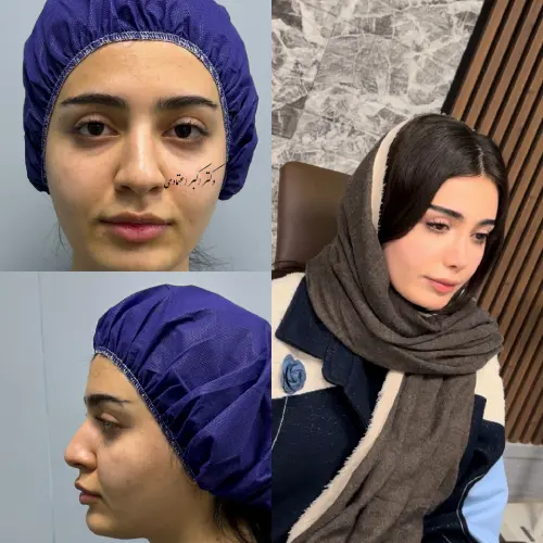 گالری نمونه کارهای دکتر آرزو خوانسارینیا نمونه کار دکتر آرزو خوانسارینیا در جراحی بینی زیبایی و ترمیمی در تهران