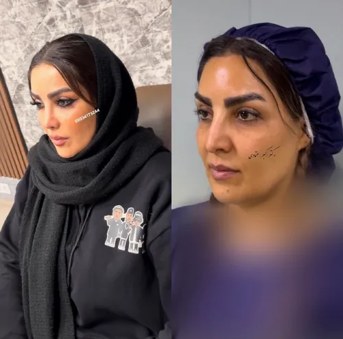 نمونه کار جراحی بینی دکتر آرزو خوانسارینیا نمونه کار جراحی بینی دکتر آرزو خوانسارینیا در تهران با تمرکز بر اصلاح فرم بینی