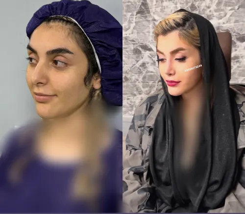 قبل و بعد جراحی بینی دکتر آرزو خوانسارینیا نمونه قبل و بعد جراحی بینی دکتر آرزو خوانسارینیا برای بهبود فرم ظاهری بینی