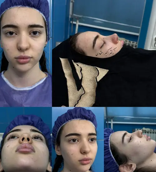 گالری نمونه کارهای دکتر امین بختیاری نمونه کار دکتر امین بختیاری در جراحی بینی زیبایی و ترمیمی در تهران