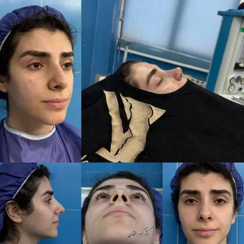 قبل و بعد جراحی بینی دکتر امین بختیاری نمونه قبل و بعد جراحی بینی دکتر امین بختیاری برای بهبود فرم ظاهری بینی
