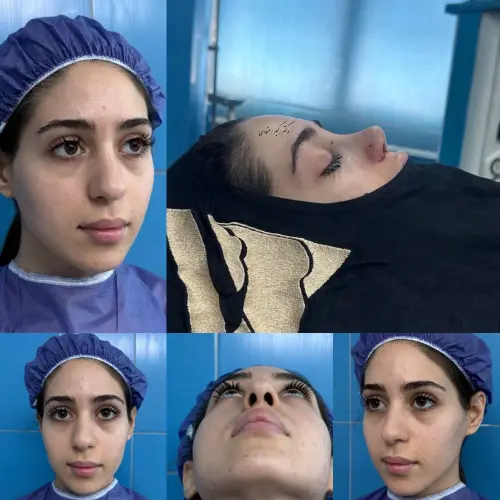 نتیجه جراحی بینی توسط دکتر امین بختیاری نتیجه جراحی بینی دکتر امین بختیاری با توجه به تناسب بینی و فرم چهره