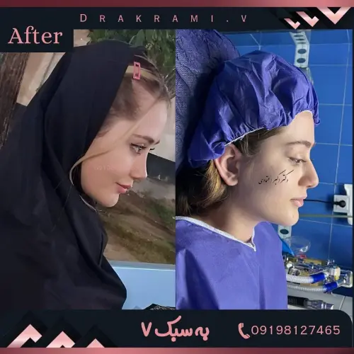 نمونه کار جراحی بینی دکتر امین بختیاری نمونه کار جراحی بینی دکتر امین بختیاری در تهران با تمرکز بر اصلاح فرم بینی
