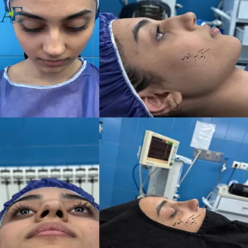 قبل و بعد عمل بینی ترمیمی دکتر اکبر اعتمادی نمونه قبل و بعد عمل بینی ترمیمی دکتر اکبر اعتمادی برای اصلاح ناهماهنگی بینی