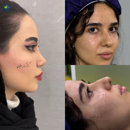 نتیجه جراحی بینی ترمیمی توسط دکتر اکبر اعتمادی نتیجه جراحی بینی ترمیمی توسط دکتر اکبر اعتمادی با بهبود تناسب بینی و چهره