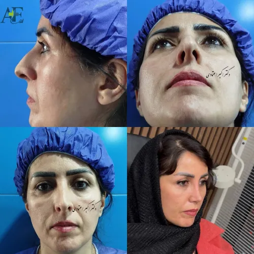 جراحی بینی ترمیمی با نتیجه طبیعی نمونه جراحی بینی ترمیمی دکتر اکبر اعتمادی با تمرکز بر حفظ تناسب طبیعی بینی