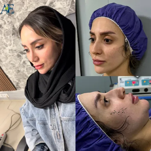 گالری نمونه کارهای دکتر اکبر اعتمادی گالری نمونه کار دکتر اکبر اعتمادی در جراحی بینی ترمیمی و زیبایی بینی