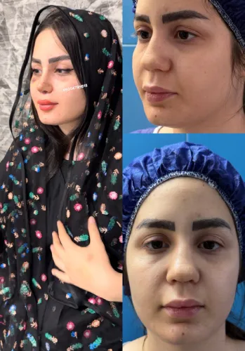 قبل و بعد جراحی بینی دکتر خسرو مقتدر نمونه قبل و بعد جراحی بینی دکتر خسرو مقتدر برای بهبود فرم ظاهری بینی