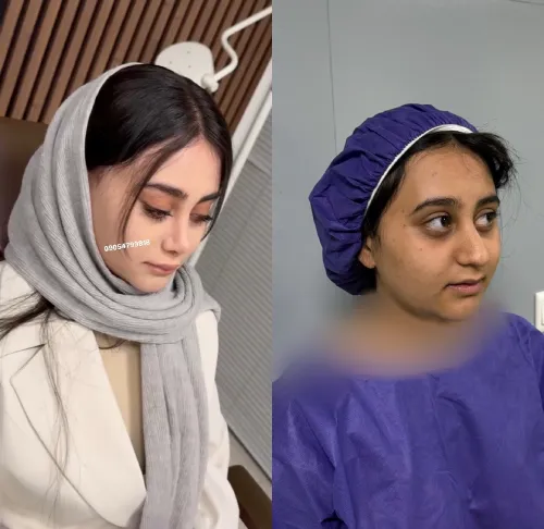 نمونه کار جراحی بینی دکتر خسرو مقتدر نمونه کار جراحی بینی دکتر خسرو مقتدر در تهران با تمرکز بر اصلاح فرم بینی