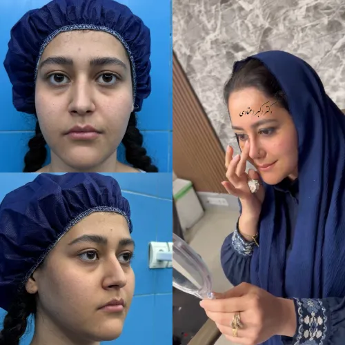 گالری نمونه کارهای دکتر خسرو مقتدر نمونه کار دکتر خسرو مقتدر در جراحی بینی زیبایی و ترمیمی در تهران