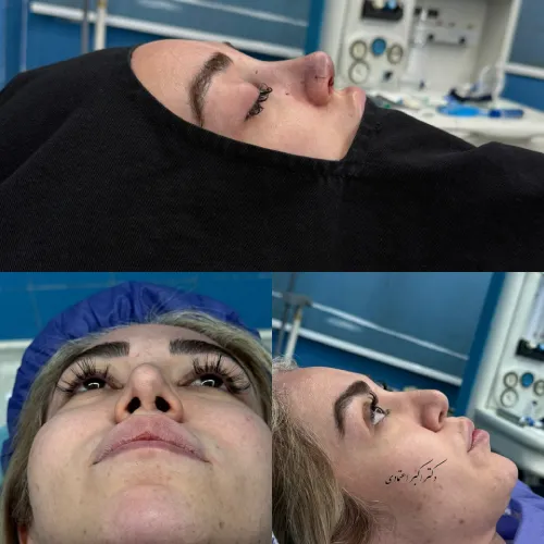 گالری نمونه کارهای دکتر علی شکرریز گالری نمونه کار دکتر علی شکرریز در جراحی بینی زیبایی و ترمیمی