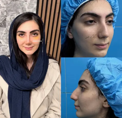 نتیجه جراحی بینی توسط دکتر علی شکرریز نتیجه جراحی بینی توسط دکتر علی شکرریز با توجه به تناسب بینی و چهره