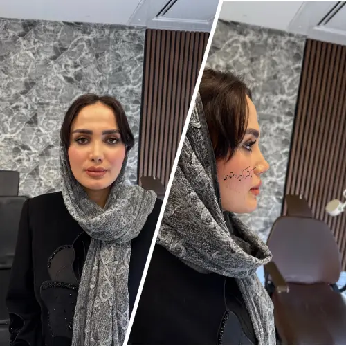 نمونه کار جراحی بینی دکتر علی شکرریز نمونه کار جراحی بینی دکتر علی شکرریز در تهران با تمرکز بر اصلاح فرم بینی