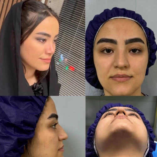نمونه رینوپلاستی عروسکی طبیعی با توجه به تقارن صورت توسط دکتر آرزو خوانسارینیا