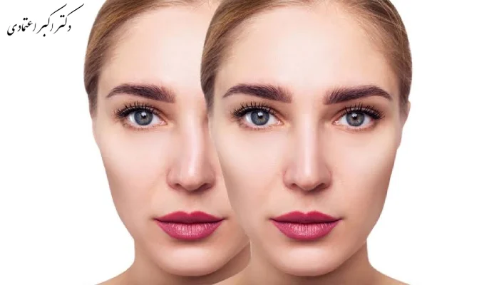 تفاوت ورم نامتقارن با کجی واقعی بینی