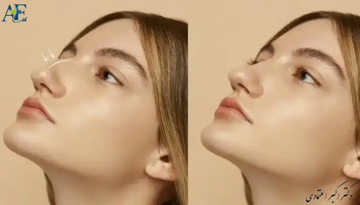 مقایسه جراحی با و بدون تامپون بینی