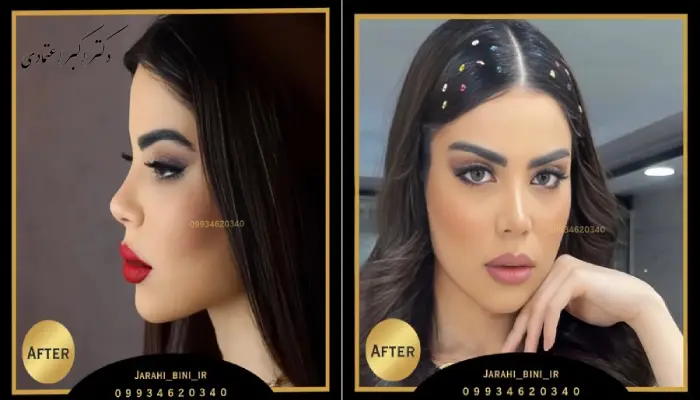 انواع جراحی بینی و تفاوت آن_ها