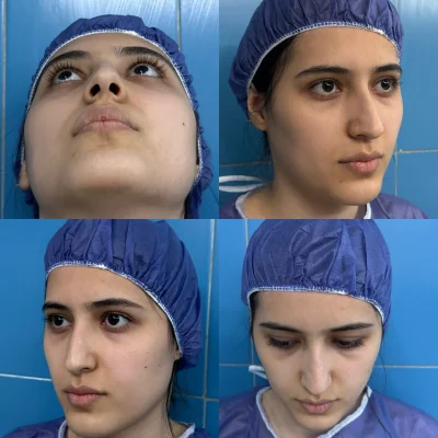 نتیجه جراحی بینی دکتر آرزو خوانساری نیا