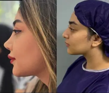 نتیجه جراحی بینی دکتر امین بختیاری