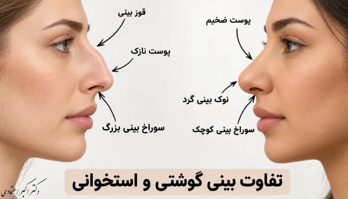 تفاوت بینی استخوانی و گوشتی